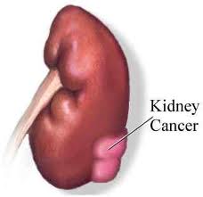 kidney cancer